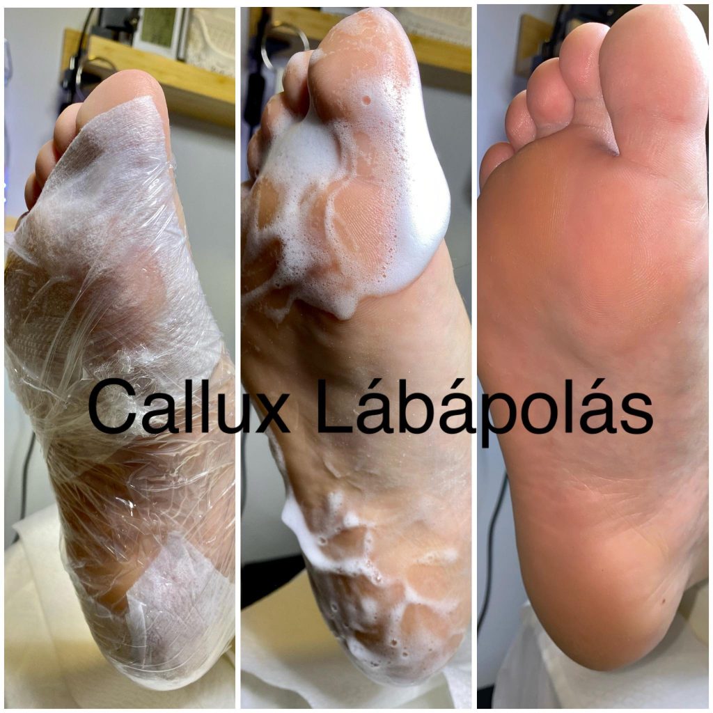 Callux term�kkel kezelt l�bfej �s talp