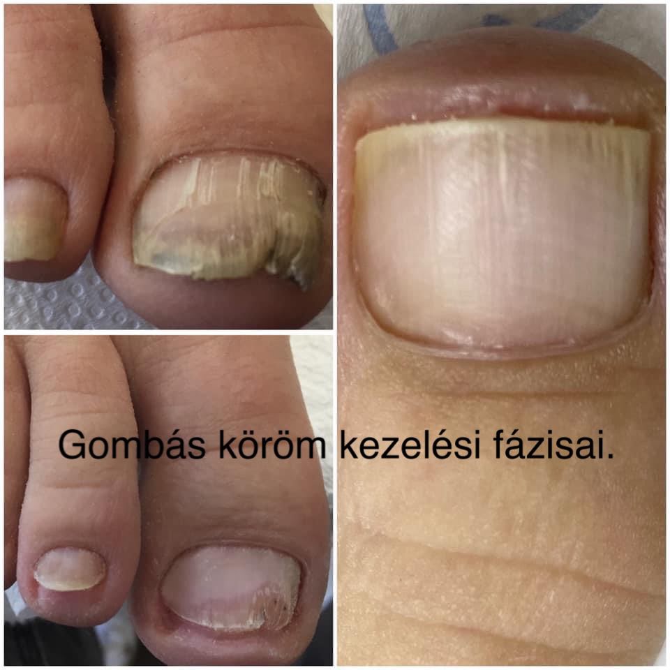 Gomb�s k�r�m kezel�si f�zisainak bemutat�sa