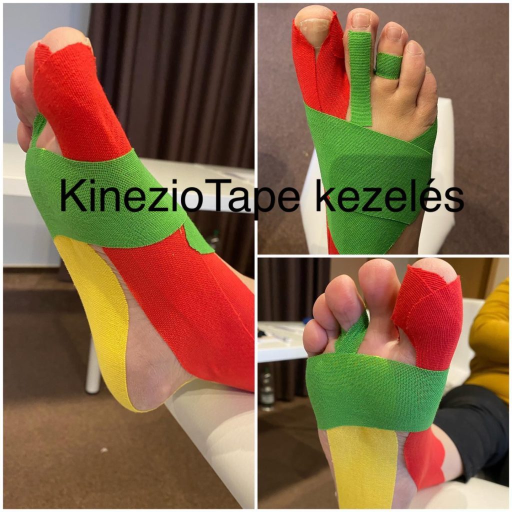 Kinezio tape alkalmaz�sa f�jdalom cs�kkent�s�re, l�bfejen