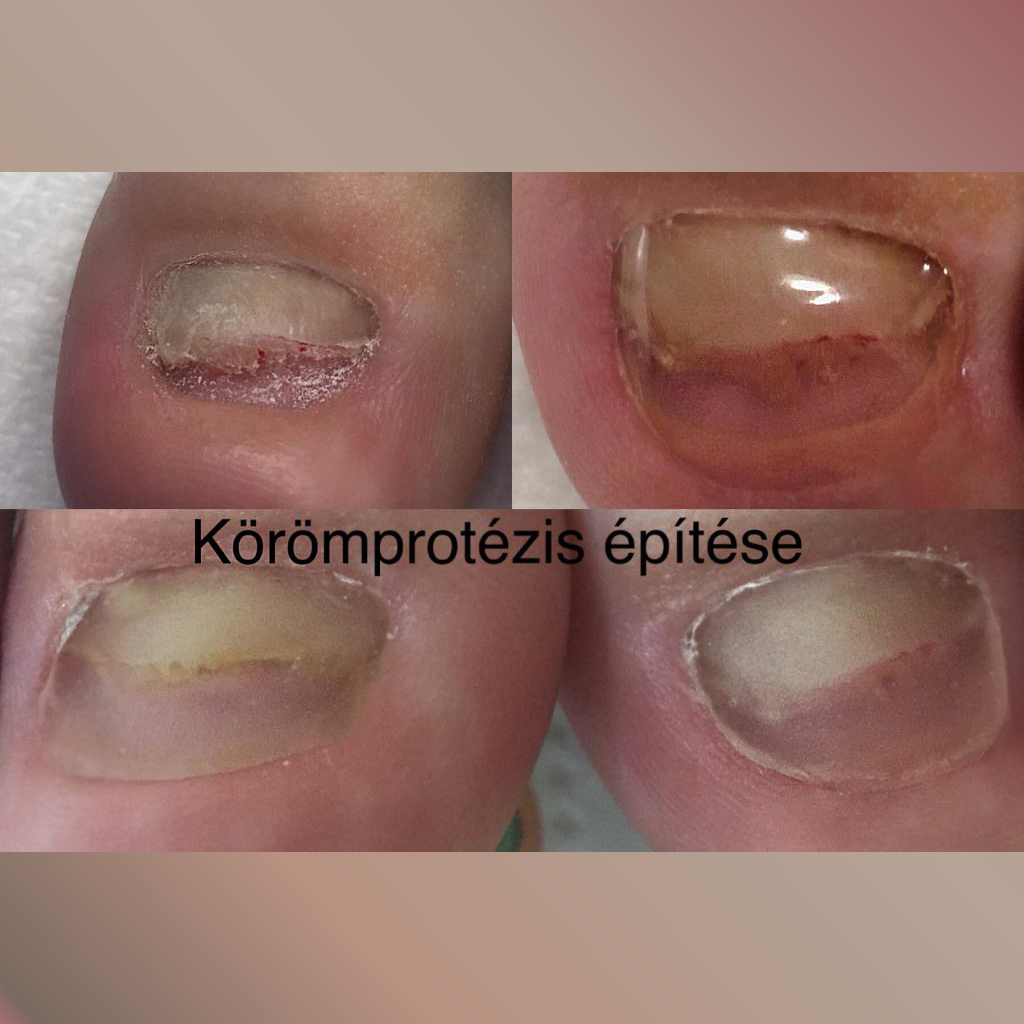 Hi�nyz� k�r�m p�tl�sa, prot�zis k�sz�t�se