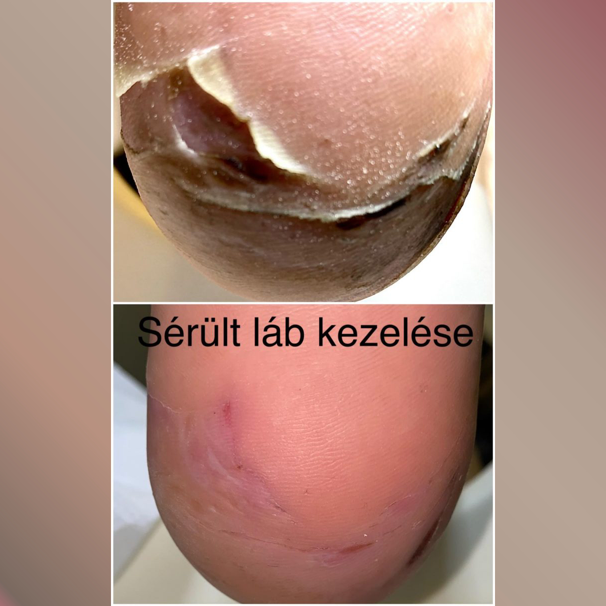 S�r�lt l�b, sarok pedik�r�s kezel�se