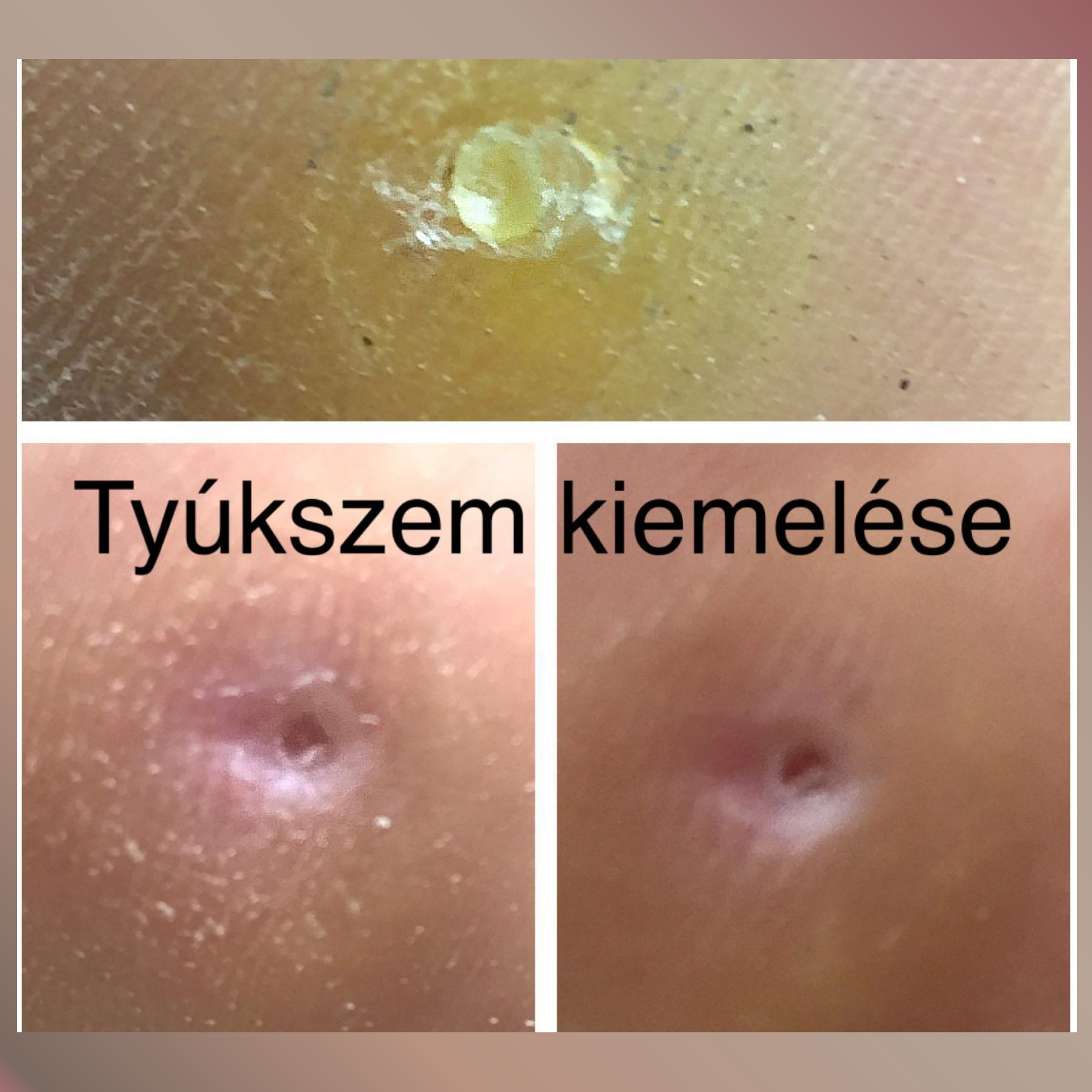 Ty�kszem pedik�r�s kezel�se